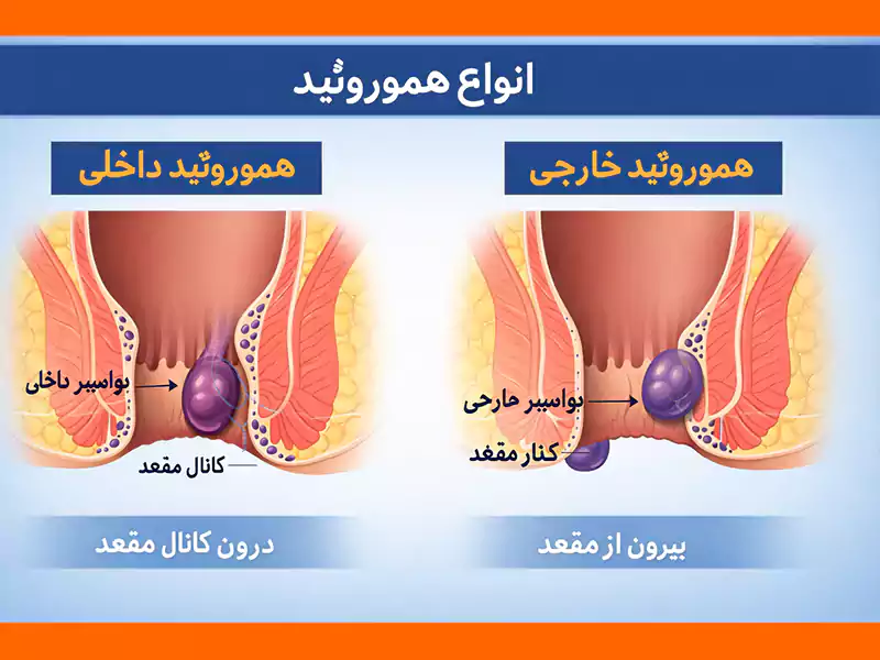 نقش داروهای خوراکی و موضعی در درمان انواع هموروئید داخلی و خارجی_thumbnail
