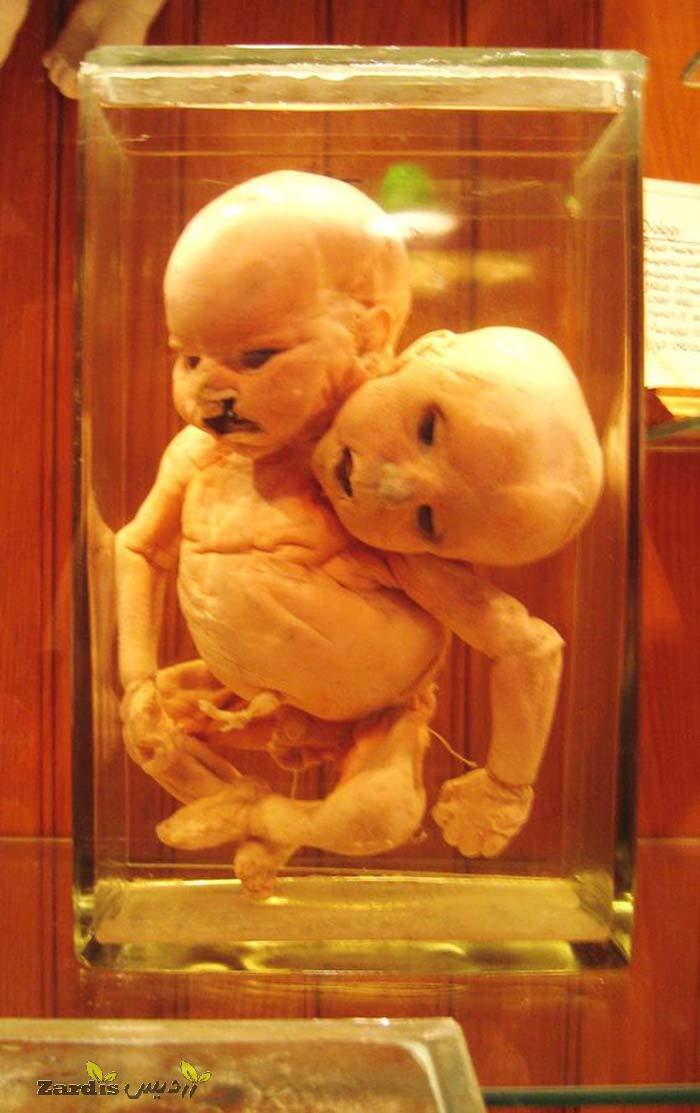 نمایش جنین دو سر در موزه ماتر